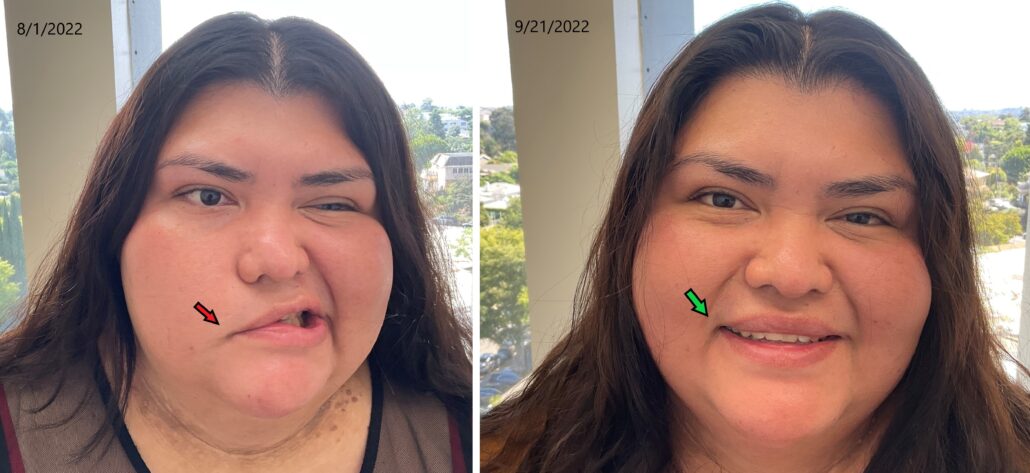 CACI Synergy delivers successful Bell's Palsy treatment